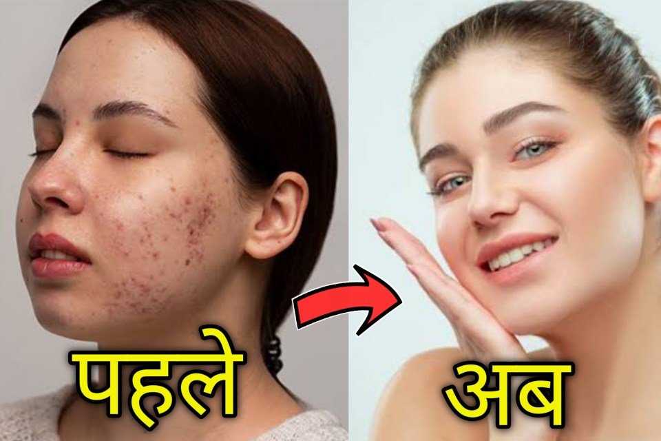 चहरे के पिंपल्स (मुहांसे) और दाग धब्बे कैसे मिटाए