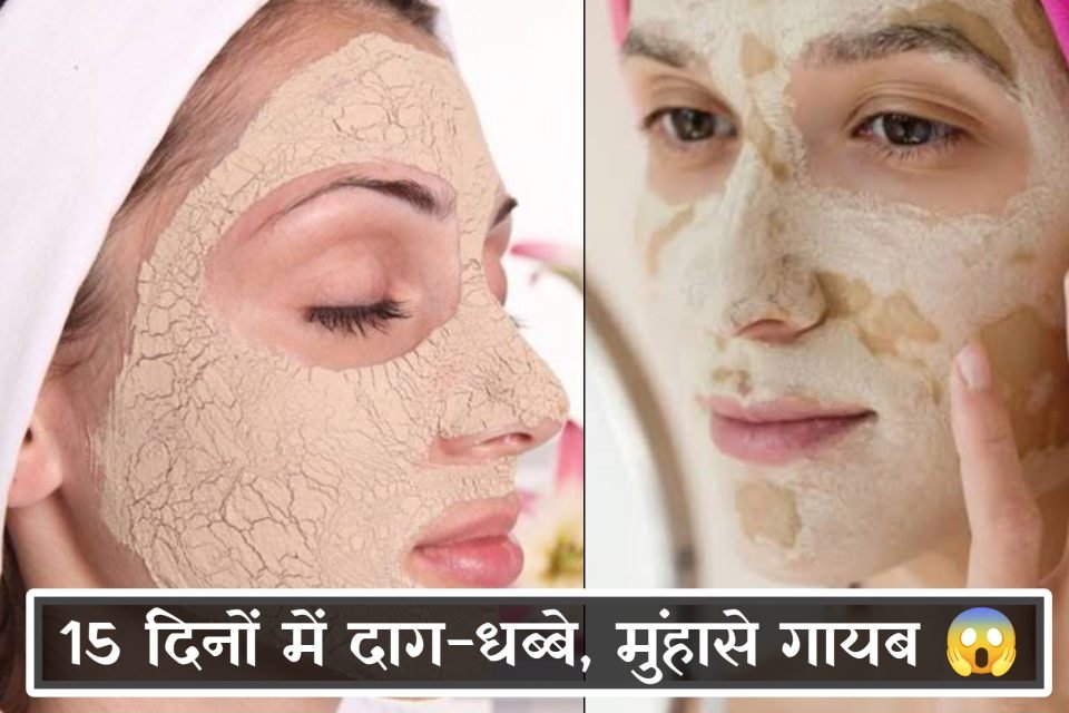 मुल्तानी मिट्टी के फायदे,
