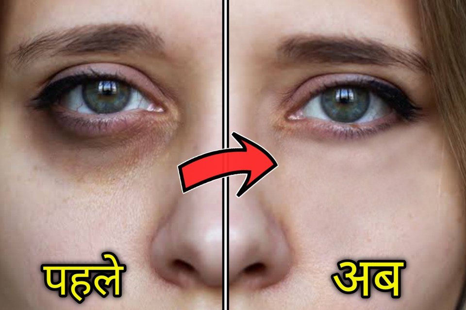 डार्क सर्कल हटाने का तरीका
